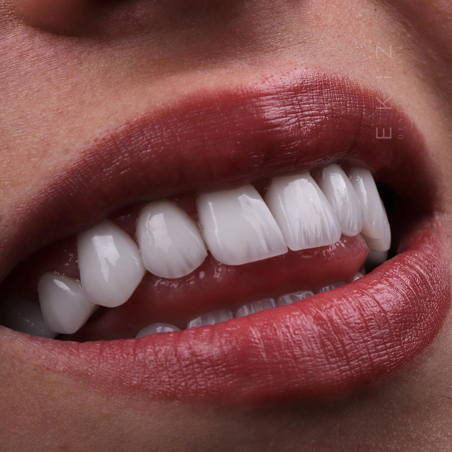 What is Laminated Dental Veneer?