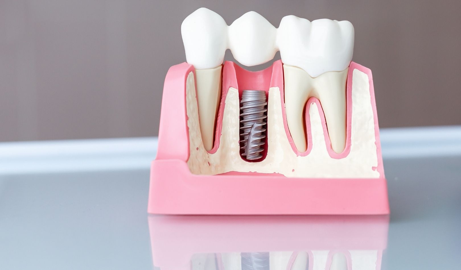How Old Can We Have a Dental Implant?