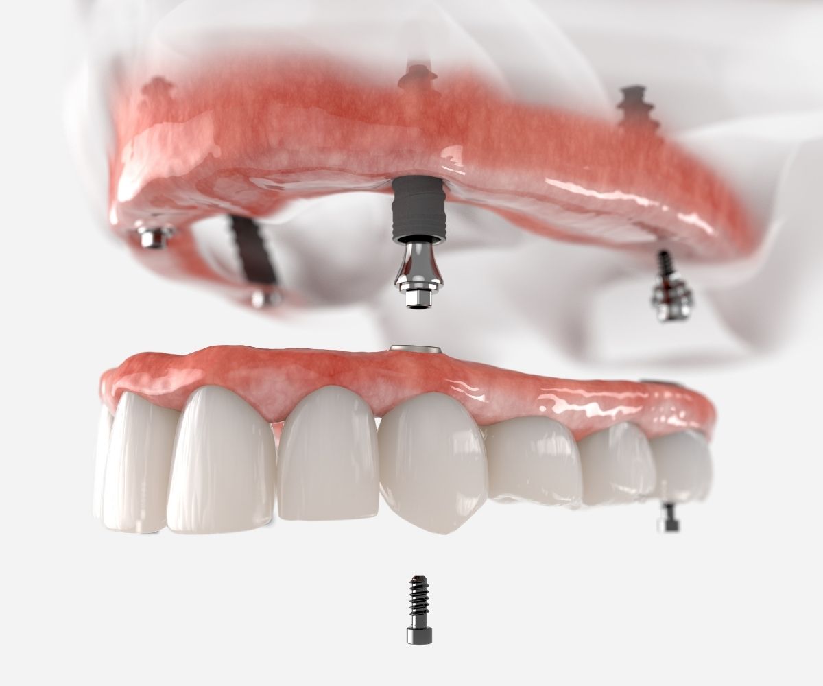 What is All on Four Implant?