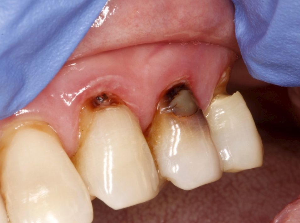 How To Prevent Tooth Root Decay?