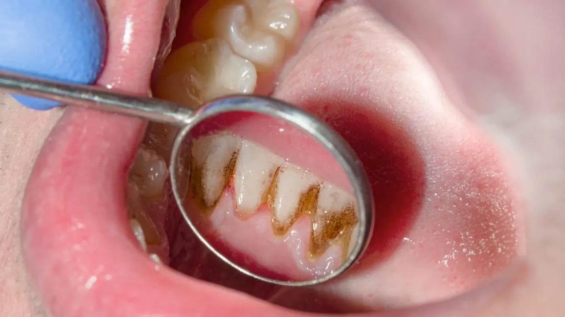 What Are The Diseases That Can Be Caused by Gingivitis?