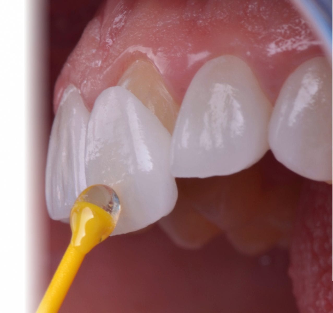 What Are The Factors Affecting The Prices of Smile Design?