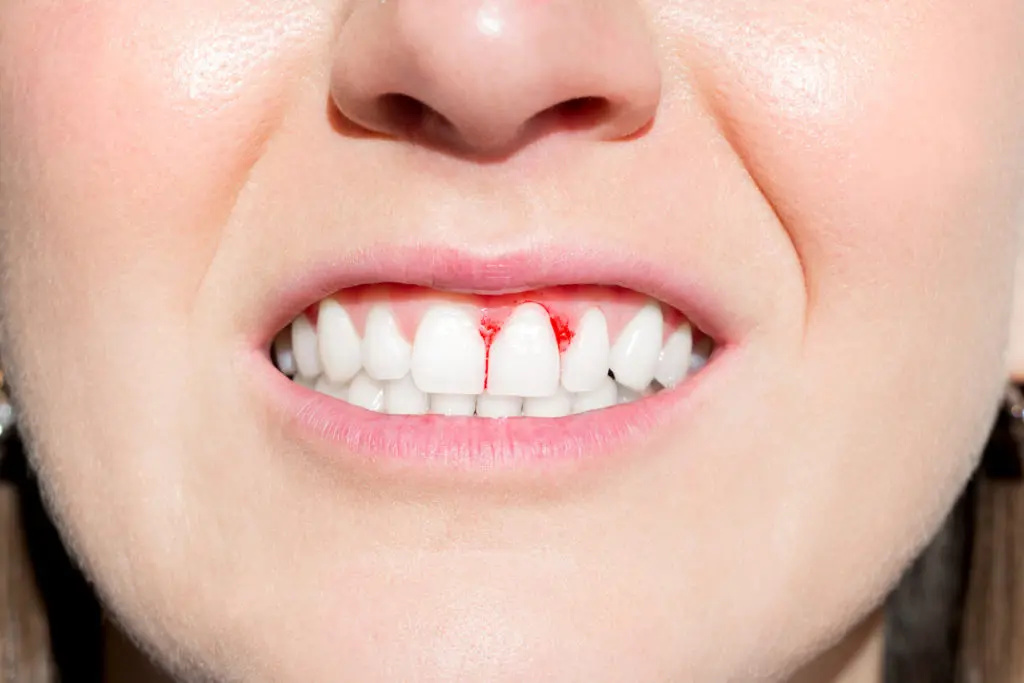 What Should Be Done in Case of Bleeding Gums?