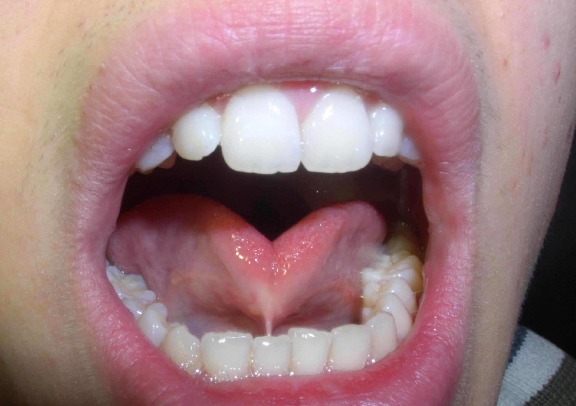 What is Lip Tie Disease?