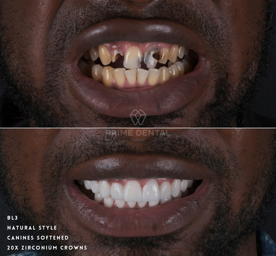 Zirconium Crown Before After Photos Prime Dental Turkey